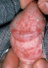 discharge from penis due to thrush